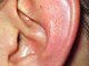 Отоларинголог: Когда в ушах растут грибы