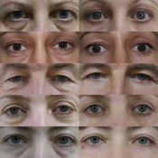 Вся правда о блефаропластике. 8611z.jpg