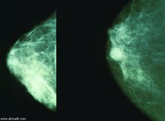 Маммо-скептики побеждают?. 9283z.jpg