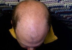 Если мало волос, их можно...пересадить!. 9468z.jpg Если мало волос, их можно...пересадить!. 9468z.jpg